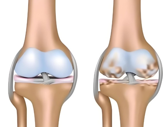 盐酸和硫酸氨基葡萄糖的作用与功效对比,应对骨关节炎如何抉择? 盐酸和硫酸氨基葡萄糖的作用与功效对比,应对骨关节炎如何抉择?